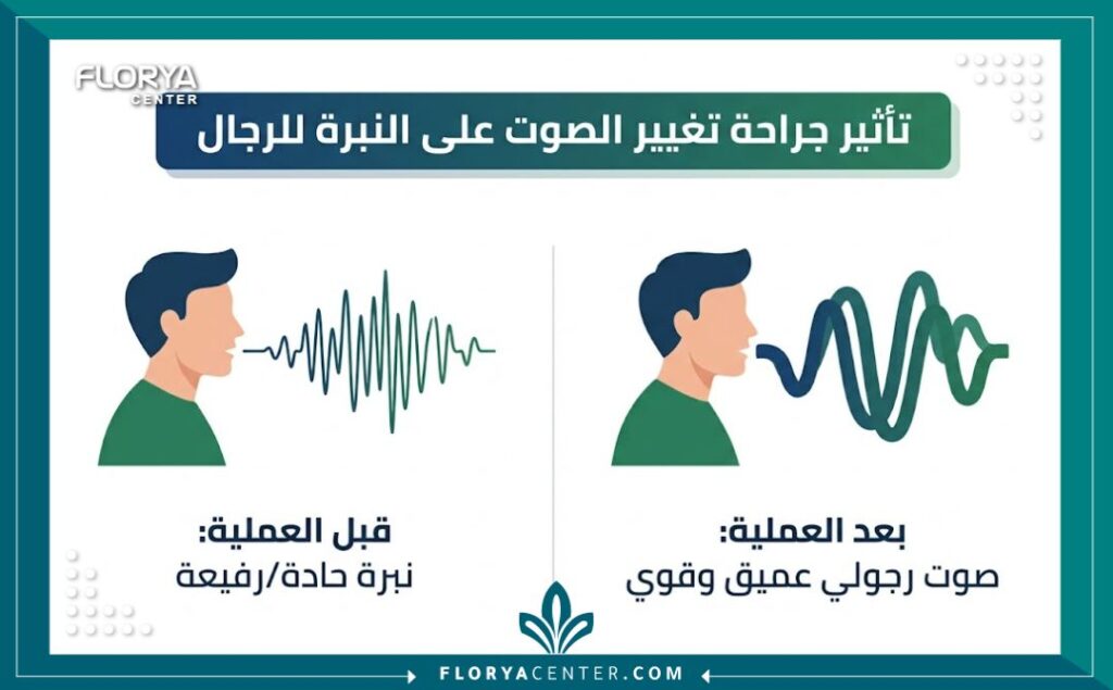 إنفوجرافيك يوضح الفرق بين نبرة الصوت الحادة للرجال قبل تغيير الصوت للذكور في تركيا والنبرة الرجولية العميقة والقوية بعد إجراء تخشين الصوت في تركيا.