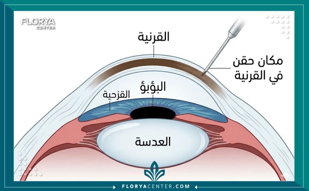 مخطط طبي تشريحي يوضح كيفية حقن الصبغة التجميلية داخل طبقات القرنية لتغيير لون العين (وليس القزحية) في تقنية Keratopigmentation المتوفرة في تركيا.