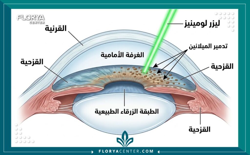 مخطط تشريحي يوضح كيفية عمل ليزر لومينيز لتغيير لون العين عبر إزالة الميلانين