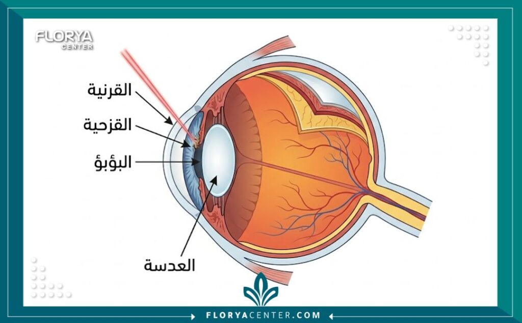 رسم تخطيطي طبي يوضح تشريح العين البشرية وكيفية عمل ليزر تغيير لون العين على طبقة القزحية.