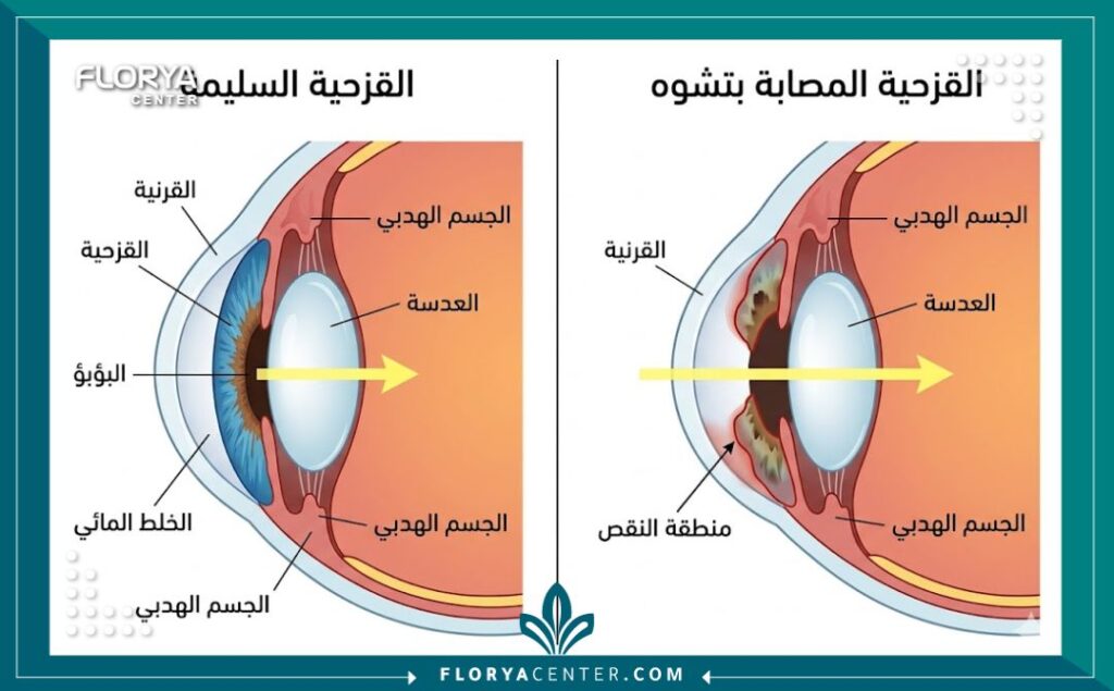مخطط طبي يوضح الفرق بين القزحية السليمة والقزحية المصابة بتشوه خلقي (مثل غياب القزحية) مما يستدعي التدخل الطبي في تركيا.