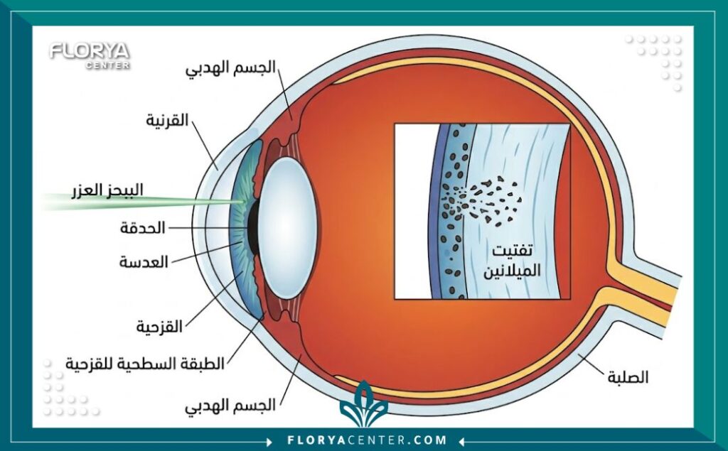 رسم توضيحي طبي تشريحي (دياغرام) يُظهر مقطعاً عرضياً للعين البشرية، موضحاً مسار شعاع الليزر عبر القرنية للوصول إلى القزحية، وكيفية استهدافه وتفتيته لحبيبات الميلانين الصبغية. جميع العناوين والتسميات التوضيحية داخل الصورة باللغة العربية الدقيقة، على خلفية بيضاء نظيفة.