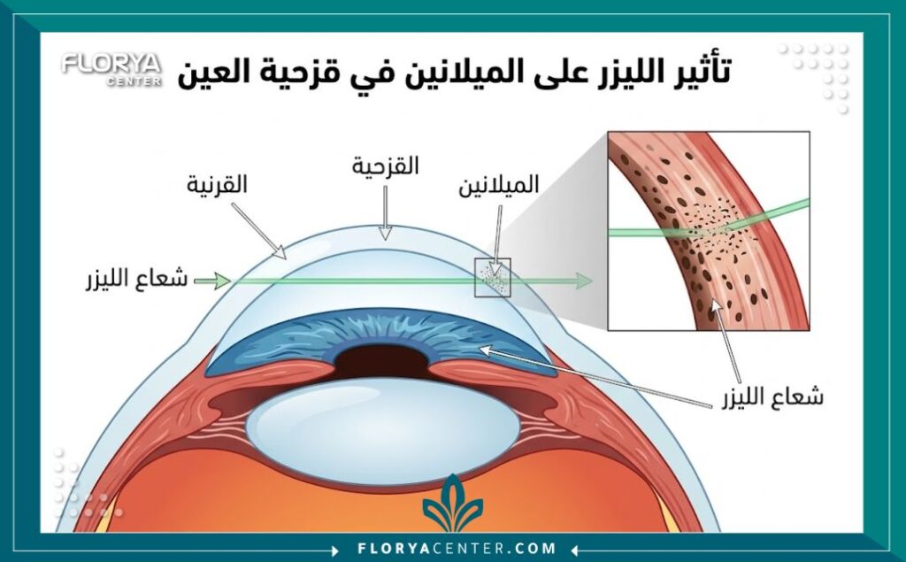 رسم تخطيطي طبي يوضح كيف يعمل الليزر لتفتيح صبغة الميلانين في القزحية لتغيير لون العين بدون جراحة.