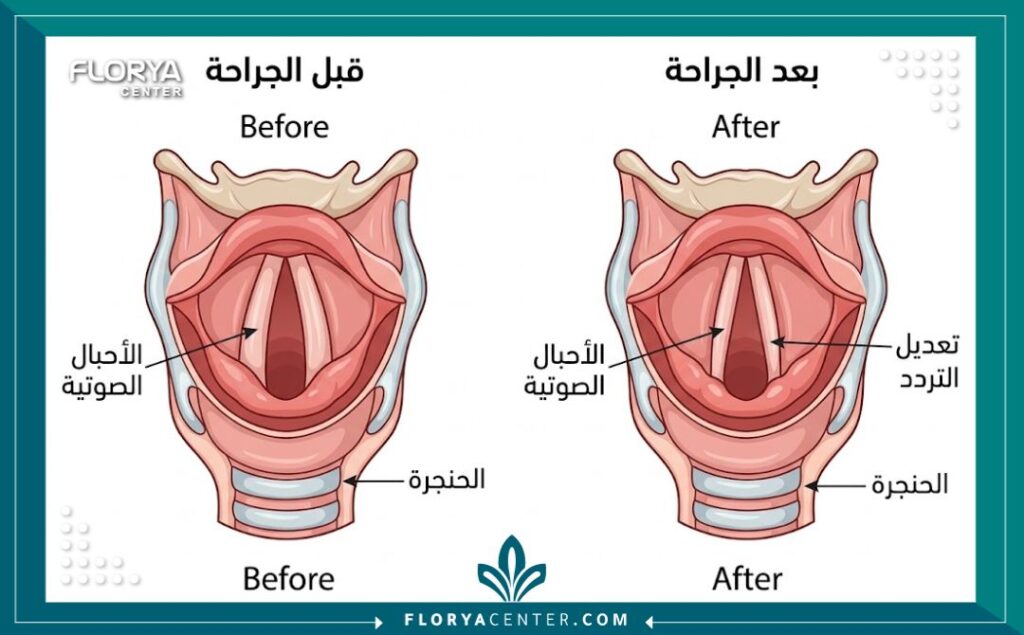 رسم تخطيطي طبي يوضح كيفية عمل عملية تغيير نبرة الصوت عبر تعديل الأحبال الصوتية.
