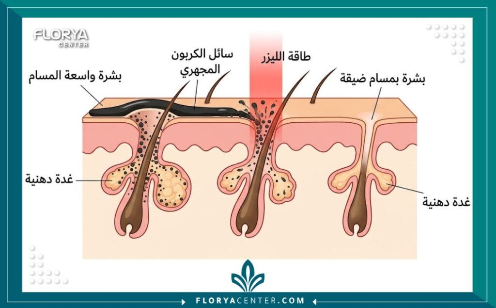 رسم توضيحي طبي يوضح آلية عمل تقشير الكربون المجهري للمسام، وكيف يستهدف الليزر جزيئات الكربون لتنظيف وتصغير المسامات الواسعة وامتصاص الدهون في الجلد.