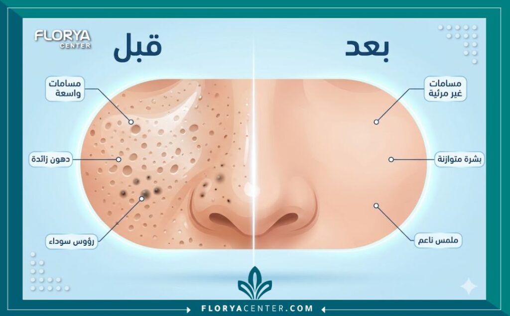 انفوجرافيك نظيف يظهر مقارنة قبل وبعد تقشير الكربون المجهري للمسام، ويوضح النتيجة المذهلة في تقليل حجم المسامات الواسعة وتنظيم إفراز الدهون للحصول على بشرة ناعمة.