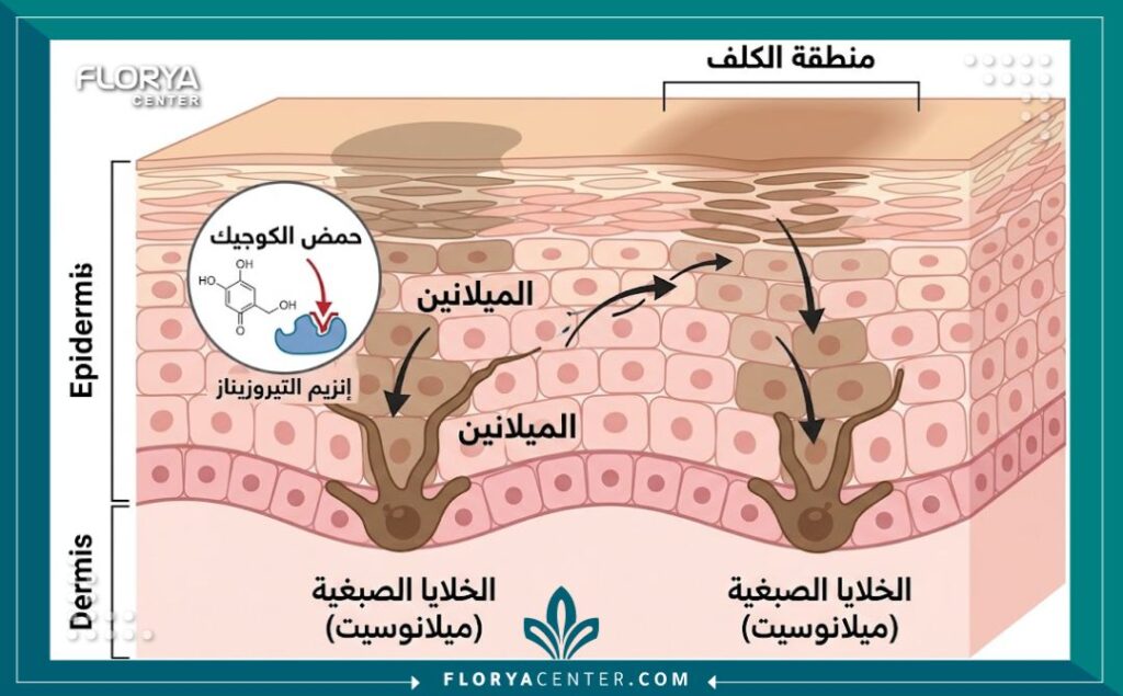 مخطط توضيحي طبي يظهر آلية عمل حمض الكوجيك في تثبيط إنتاج الميلانين لعلاج الكلف بعمق.