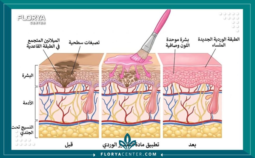 رسم تخطيطي طبي يوضح كيفية عمل تقنية التقشير الوردي على طبقات جلد الشفاه لإزالة الميلانين وتوريد الشفايف.