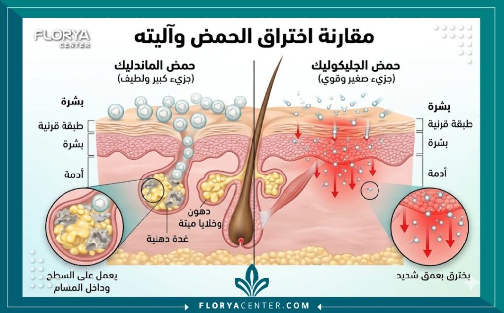 مخطط طبي يوضح كيف يعمل جزيء حمض الماندليك الكبير على سطح البشرة الدهنية دون اختراق عميق.