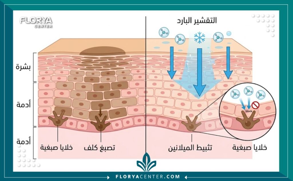 رسم توضيحي طبي لطبقات الجلد يوضح آلية عمل قناع التقشير البارد في تغلغله نحو الخلايا الصبغية لتثبيط إنتاج الميلانين وعلاج تصبغات الكلف.