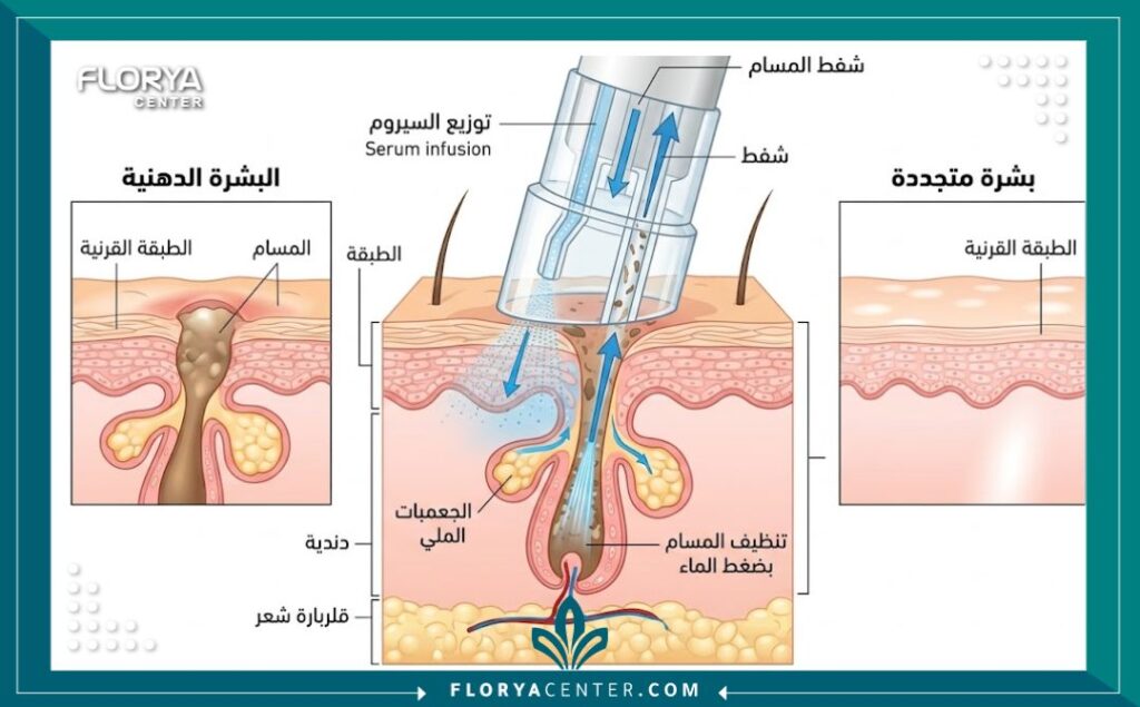 مخطط توضيحي طبي يظهر كيفية عمل تقنية التقشير المائي لتنظيف المسام العميقة باستخدام ضغط الماء والسيرومات.