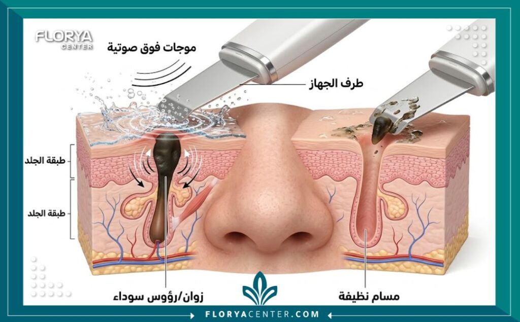 رسم توضيحي طبي ثلاثي الأبعاد يوضح آلية عمل جهاز التقشير بالموجات فوق الصوتية في تفتيت وإزالة الزوان والرؤوس السوداء من مسام الجلد دون ألم.