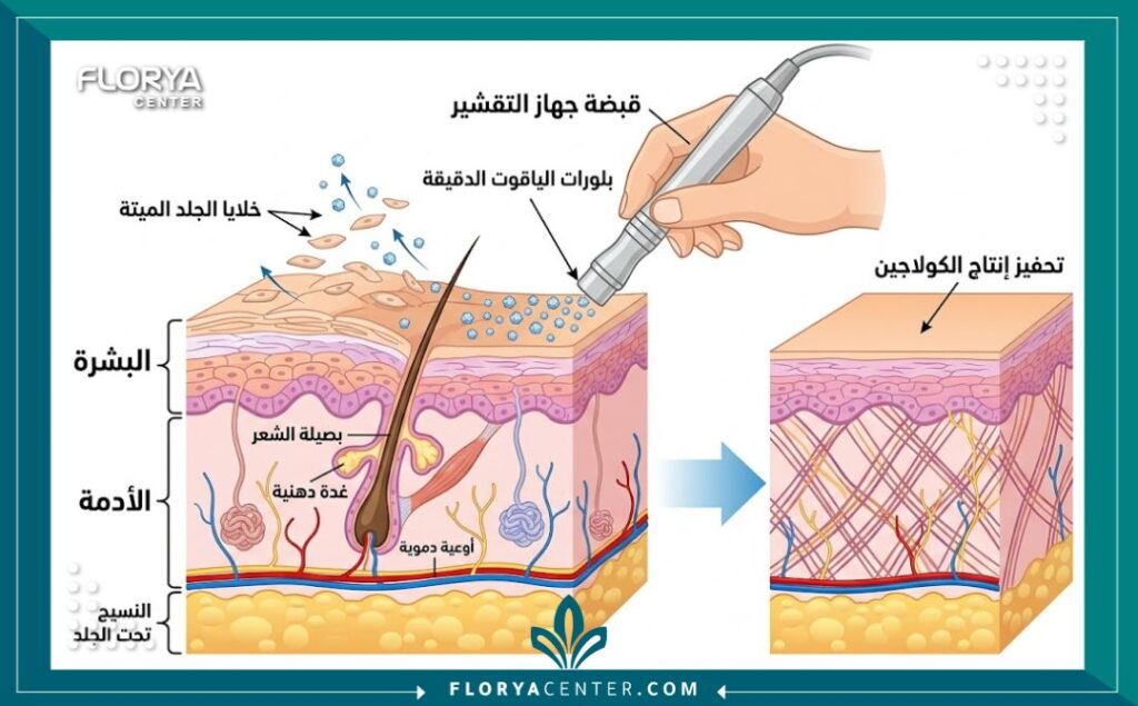 رسم توضيحي طبي (مخطط تشريحي) يبين كيفية عمل تقنية التقشير ببلورات الياقوت في تركيا على طبقات الجلد لإزالة الخلايا الميتة وتحفيز الكولاجين، مع تسميات باللغة العربية.