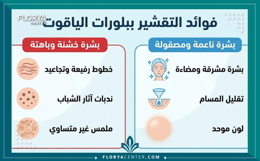 إنفوجرافيك للمقارنة يوضح فوائد التقشير ببلورات الياقوت في تركيا، ويقارن بين حالة البشرة قبل العلاج (باهتة وخشنة) وبعده (ناعمة ومصقولة)، مع أيقونات ونص عربي.