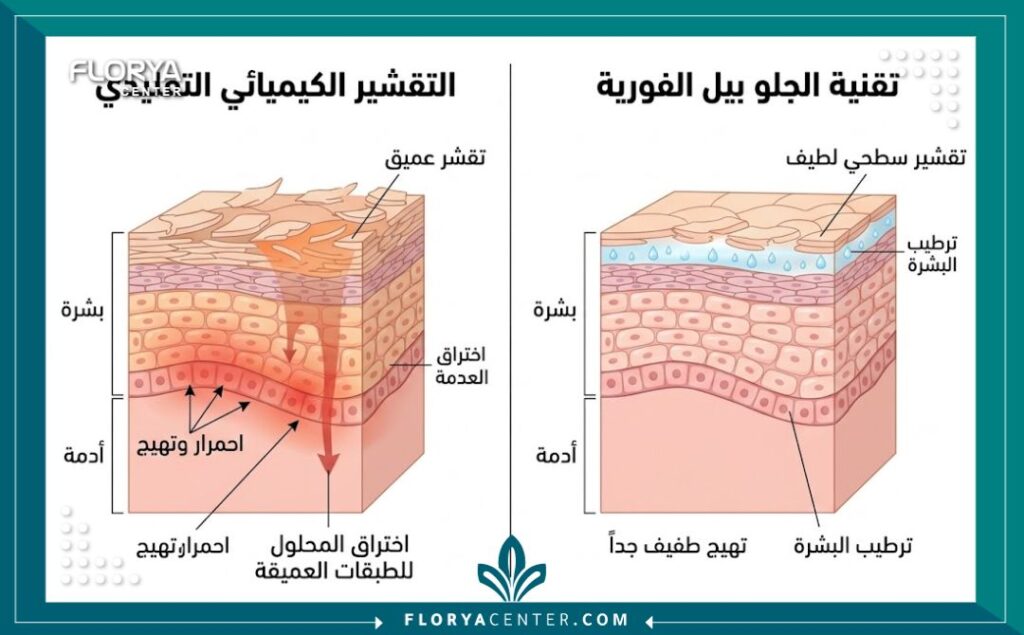 مخطط طبي يوضح آلية عمل تقنية الجلو بيل الفورية في تقشير السطح فقط ومقارنتها بالتقشير التقليدي الأعمق.
