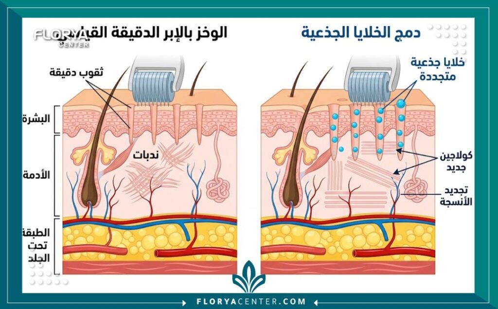 رسم توضيحي طبي يبين آلية عمل تقنية الميكرو-نيدلينج مع الخلايا الجذعية في الجلد لعلاج الندبات وتحفيز الكولاجين.
