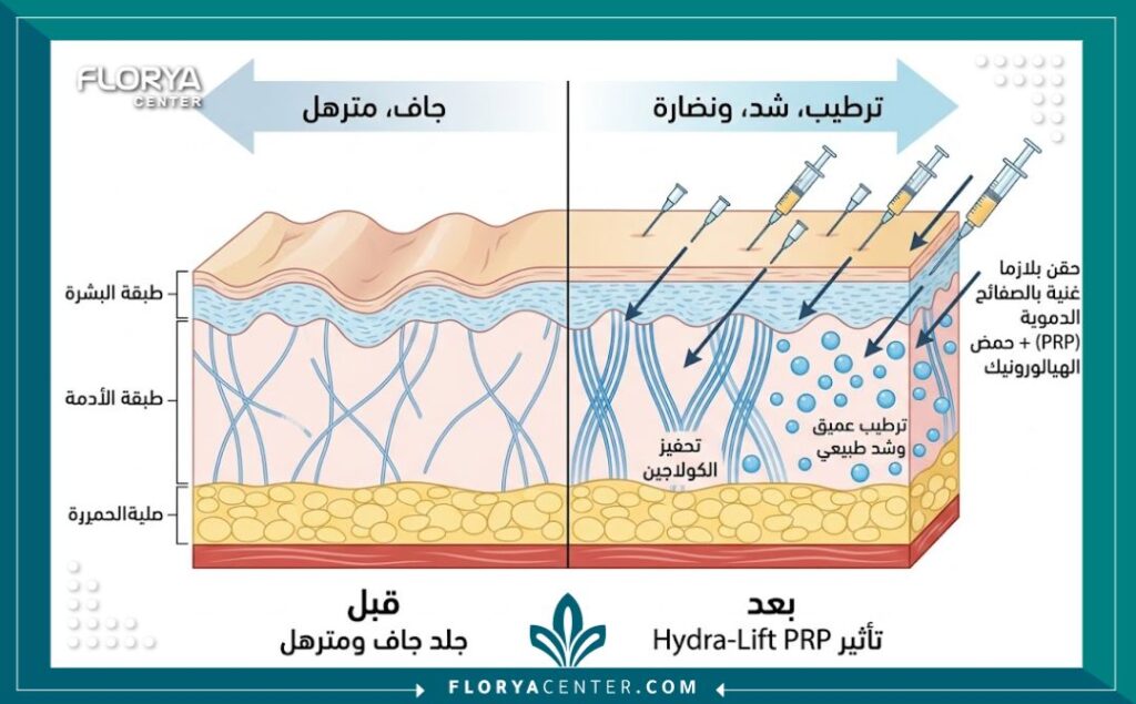 رسم بياني طبي يوضح كيفية عمل حقن البلازما (PRP) مع الهيدرو-لفت لشد الجلد وتحفيز الكولاجين في طبقات البشرة