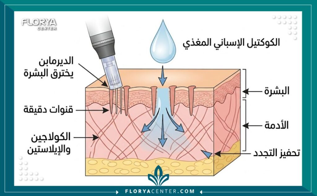 مخطط توضيحي طبي يظهر كيفية اختراق إبر الديرمابن لطبقات الجلد وتغلغل الكوكتيل الإسباني لتحفيز الكولاجين وتجديد البشرة في تركيا.