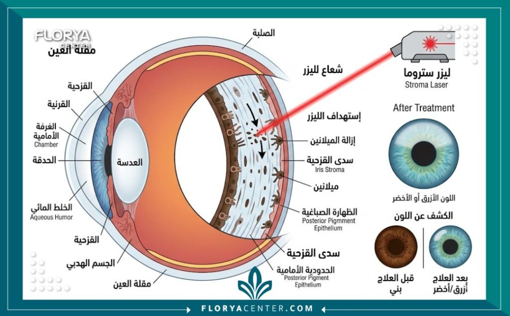 رسم تخطيطي طبي تشريحي يوضح كيفية عمل ليزر ستروما على طبقة قزحية العين لتغيير اللون، مع بيانات باللغة العربية.