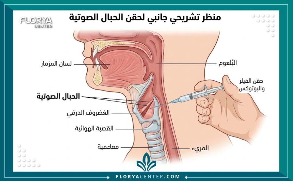 رسم تخطيطي طبي يوضح عملية حقن الحبال الصوتية بالبوتوكس أو الفيلر في عيادات تركيا.