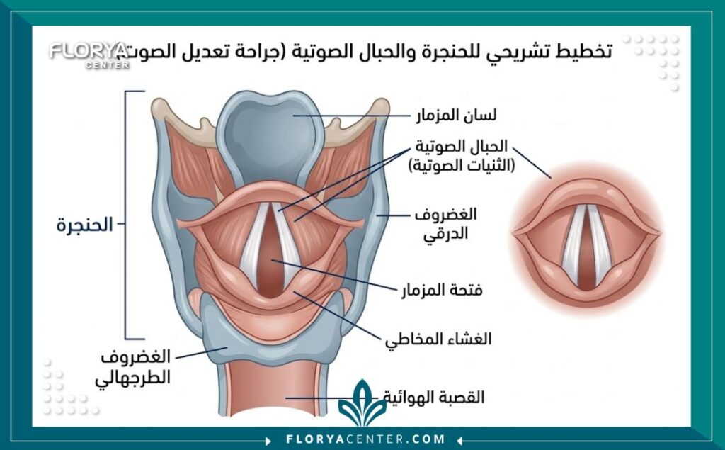 مخطط تشريحي طبي يوضح هيكل الحنجرة والحبال الصوتية المستهدفة في جراحة تجميل الصوت.