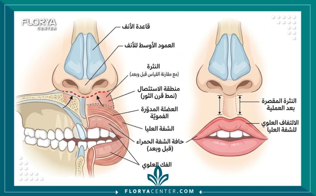 رسم توضيحي طبي يشرح خطوات عملية رفع الشفة العلوية (ليب لفت) عبر تقنية شق قرن الثور تحت الأنف.