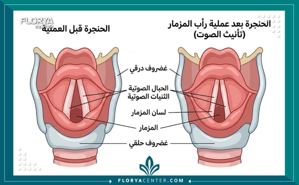 مخطط طبي يوضح تشريح الحنجرة والتغيرات في الحبال الصوتية قبل وبعد عملية Glottoplasty لتنعيم الصوت.