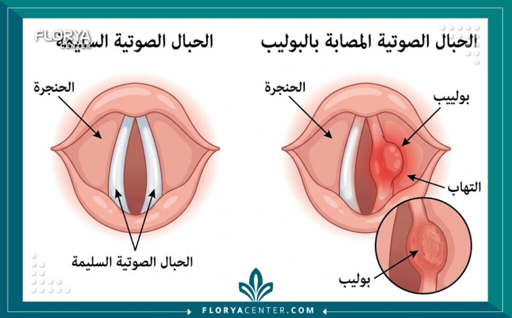 رسم توضيحي طبي يقارن بين الحبال الصوتية السليمة والحبال الصوتية المصابة بالبولييبات، مع تسميات دقيقة باللغة العربية.
