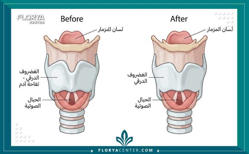 جراحة الحنجرة التجميلية في تركيا 2 مخطط طبي يوضح تشريح الحنجرة وعملية تصغير تفاحة آدم (الغضروف الدرقي).