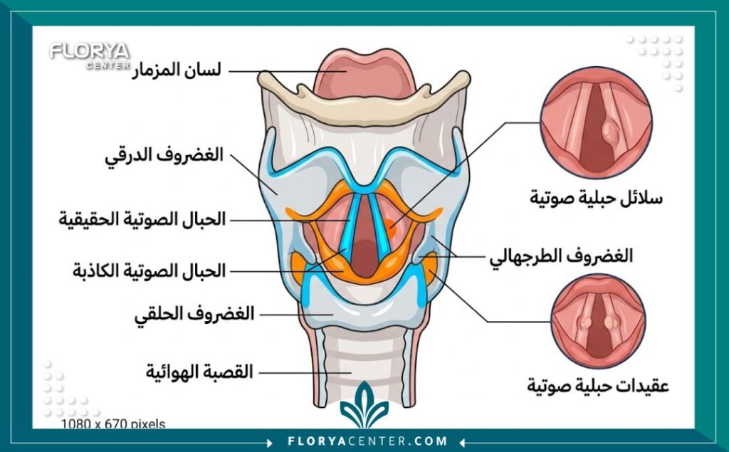 رسم تخطيطي طبي يوضح تشريح الحنجرة والأحبال الصوتية والمشاكل الشائعة مثل اللحميات والعقيدات الصوتية.