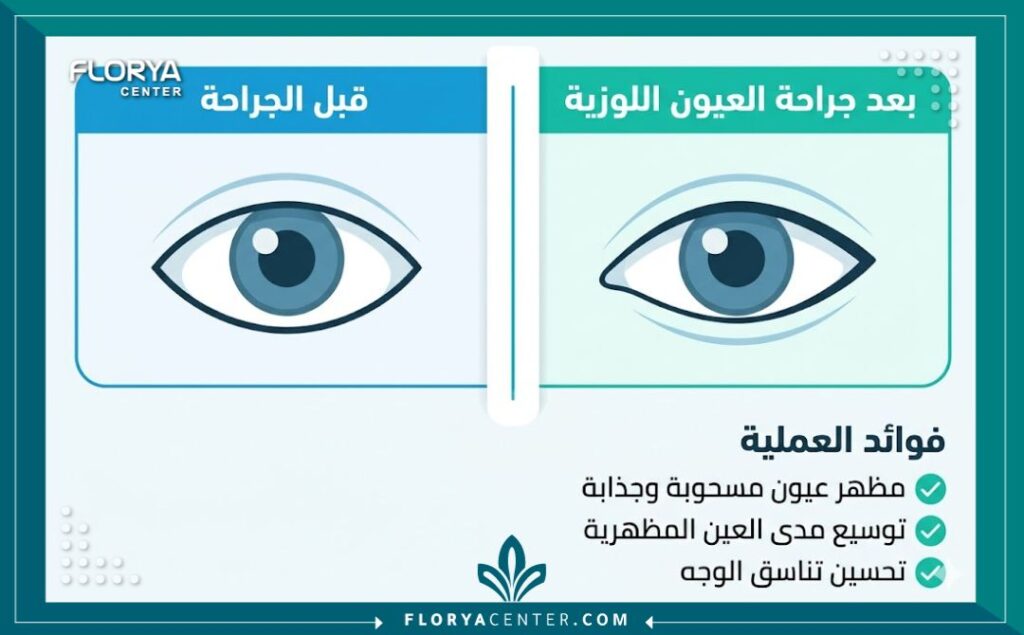 جراحة العيون اللوزية في تركيا 3 انفوجرافيك مقارنة قبل وبعد عملية العيون اللوزية في تركيا، توضح الشكل المسحوب والجذاب للعين.