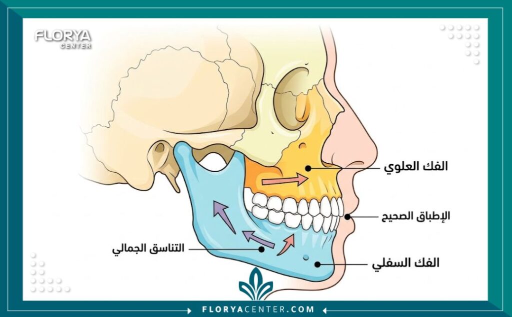 مخطط طبي تشريحي يوضح عملية إعادة تموضع عظام الفك العلوي والسفلي لتحقيق التناسق الجمالي والوظيفي للوجه.