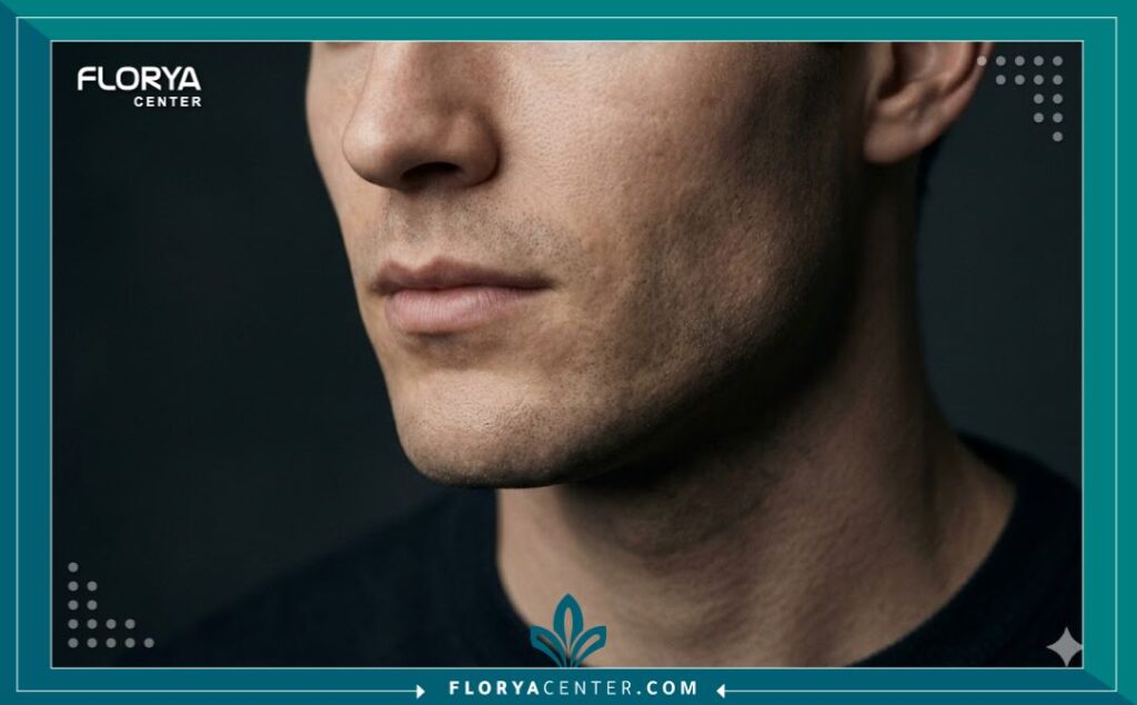 لقطة قريبة تبرز تحديد الفك (Jawline) والذقن للرجل بعد جراحة الفك التقويمية الجمالية، موجهة للبحث عن تجميل الوجه الذكوري.