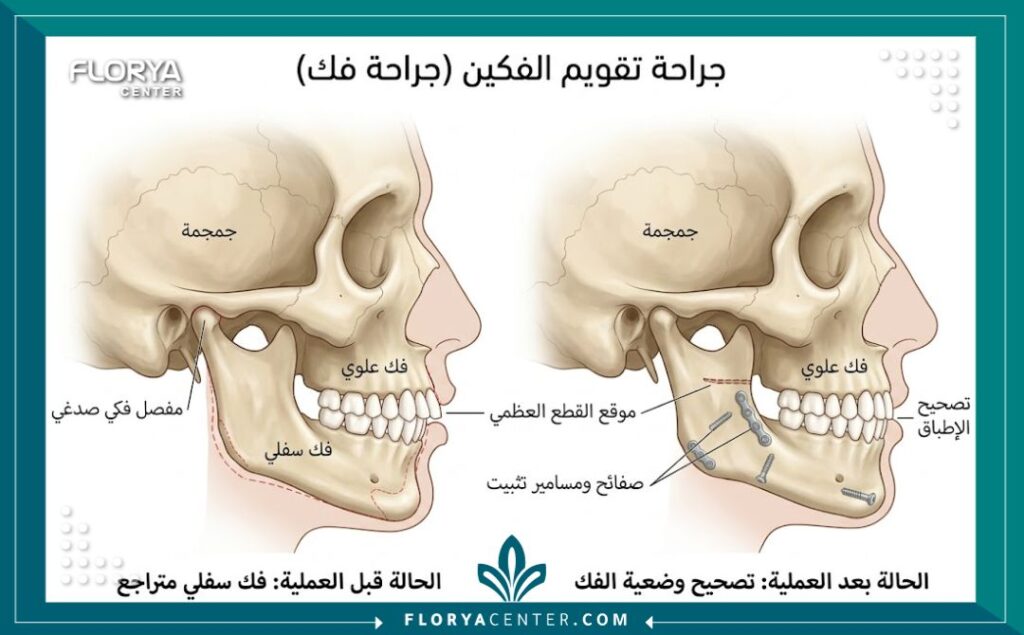 رسم توضيحي طبي يبين تشريح عظام الوجه وعملية تصحيح تراجع أو بروز الفك السفلي العظمي.