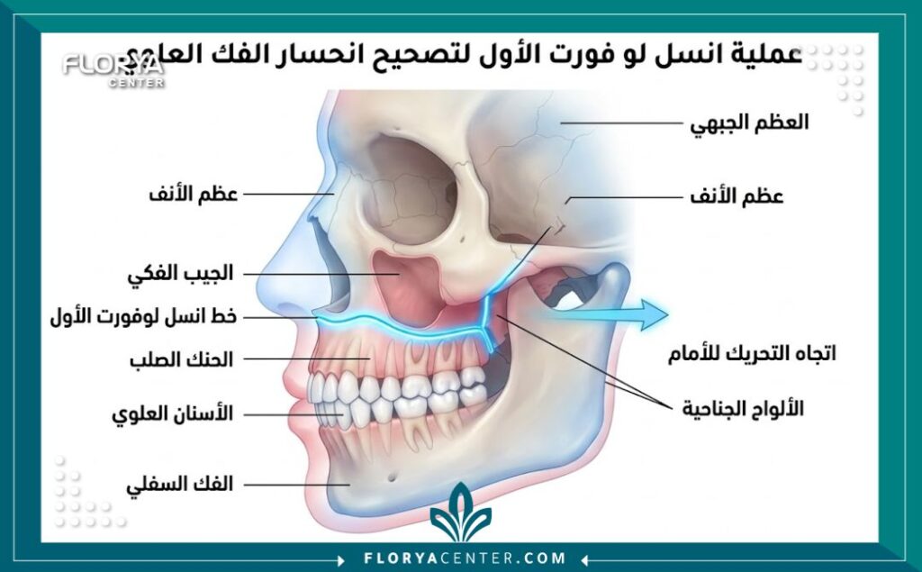 رسم توضيحي طبي ثلاثي الأبعاد يشرح تشريح عظام الفك العلوي وخطوات العلاج الجراحي لتراجع الفك.