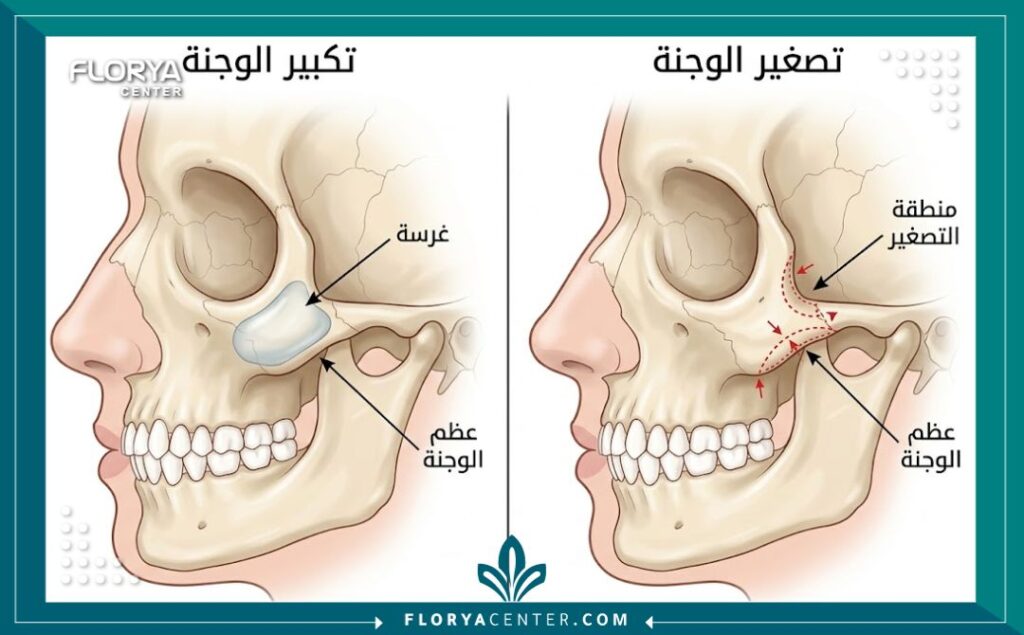 رسم تخطيطي طبي يوضح تشريح عظام الخد والفرق بين تكبير الخدود بالغرسات وتصغير عظام الوجه.
