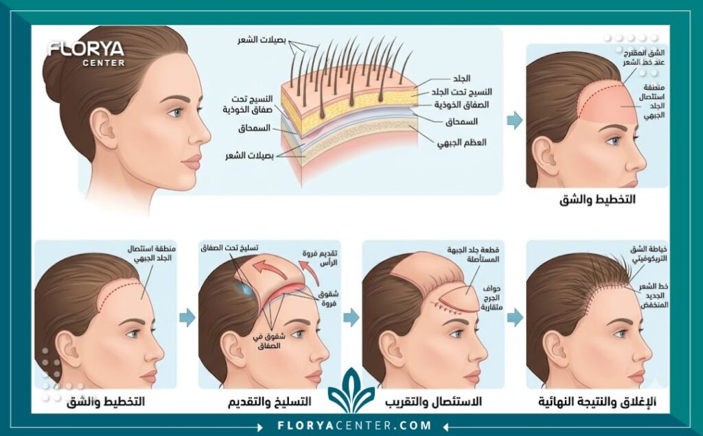 رسم توضيحي طبي يشرح تشريح الجبهة وخطوات عملية إنزال خط الشعر لمعالجة الجبهة العريضة.