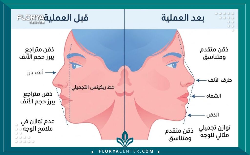 جراحة تقديم الذقن 3 إنفوجرافيك يوضح الفرق بين الذقن المتراجع والخلفي مقارنة بالذقن الطبيعي المتقدم ومدى تأثيره على حجم الأنف وتناسق الوجه.