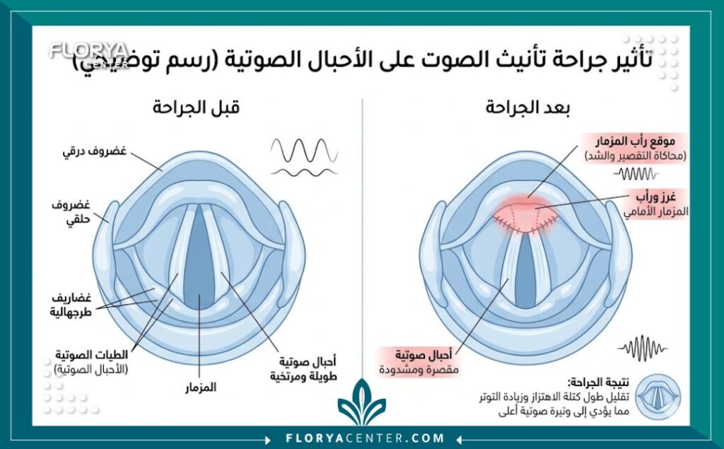 مخطط طبي يوضح كيفية تقصير وتعديل الأحبال الصوتية في عملية رفع طبقة الصوت.