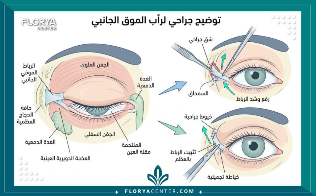 رسم توضيحي طبي يشرح تشريح العين وآلية عمل عملية شد زاوية العين أو الكانتوبلاستي.
