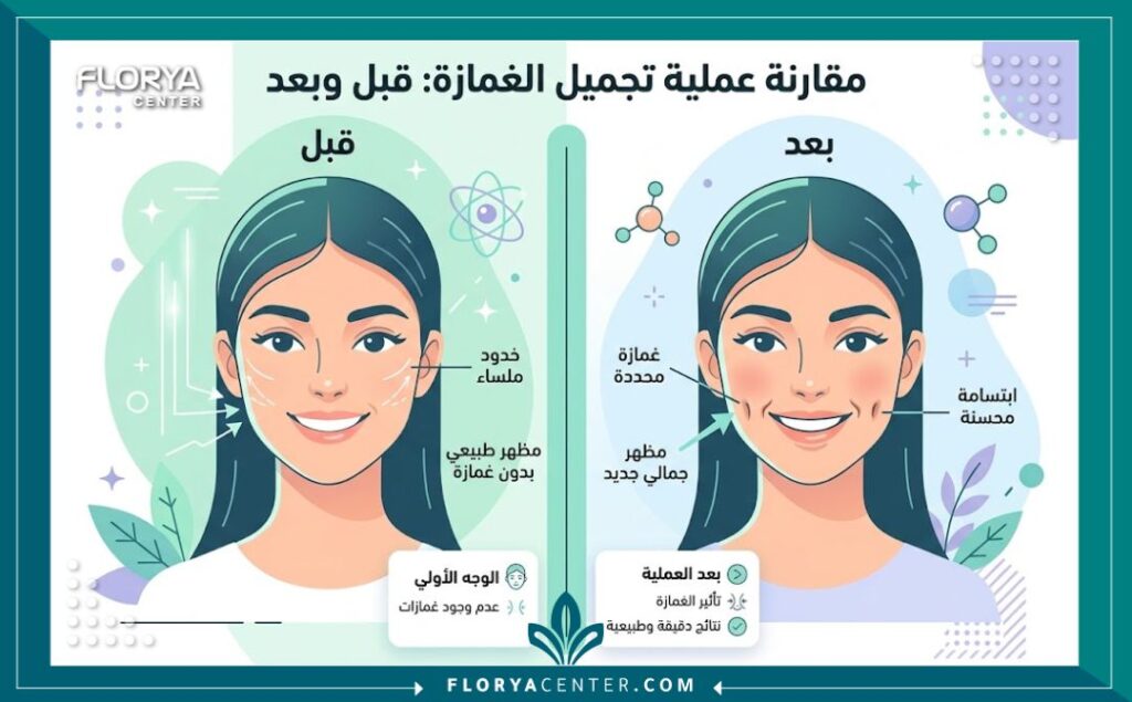 إنفوجرافيك يقارن نتائج الابتسامة قبل وبعد عملية غمازات الوجه الدائمة.