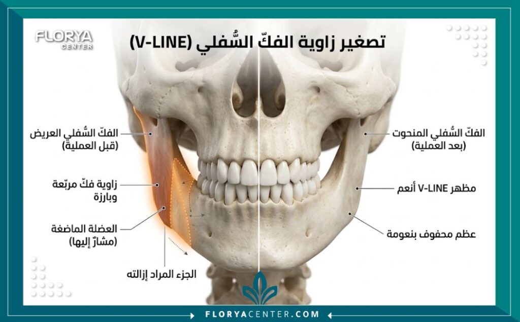 رسم توضيحي طبي يوضح تشريح الفك السفلي وكيفية تكسير وقص زوايا الفك العريضة في جراحة V-Line.