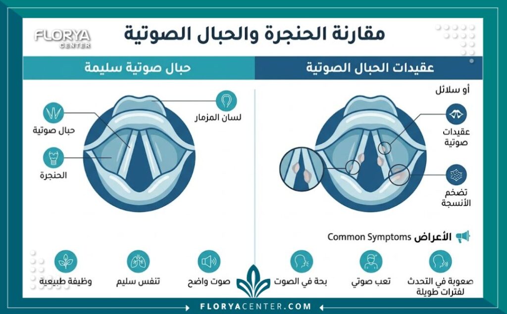  إنفوجرافيك طبي يوضح الفرق بين الحبال الصوتية السليمة والمصابة بالعقيدات لمساعدة المرضى على فهم التشخيص الفحصي.