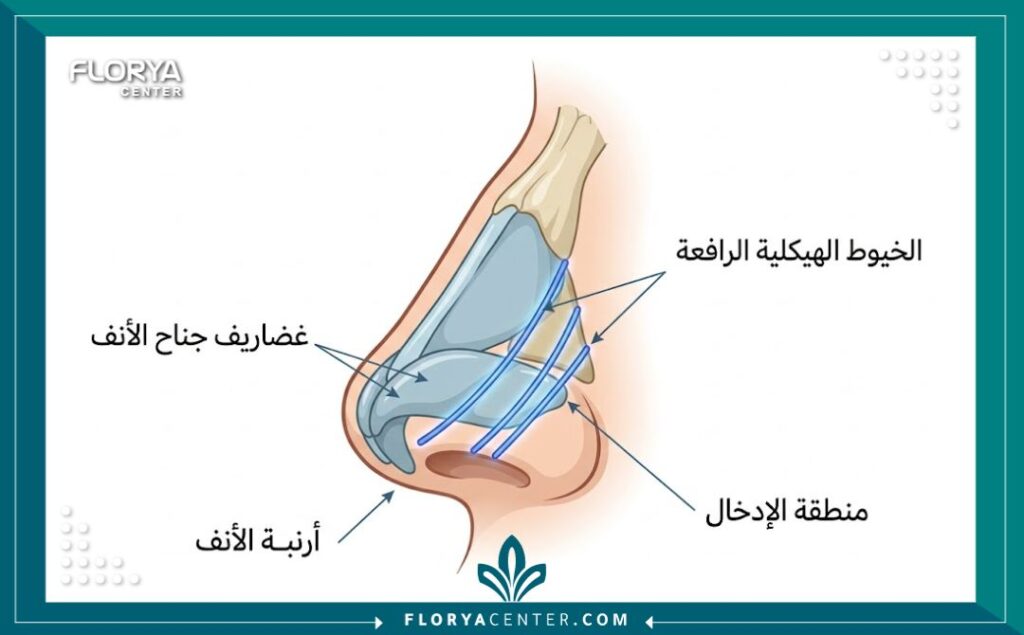 مخطط طبي يوضح كيفية زرع الخيوط الهيكلية لرفع غضاريف أرنبة الأنف المتهدلة.