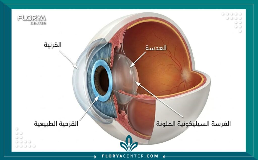 مخطط طبي يوضح كيفية وضع زرعة القزحية السيليكونية الملونة فوق القزحية الطبيعية في عملية تجميل العيون.