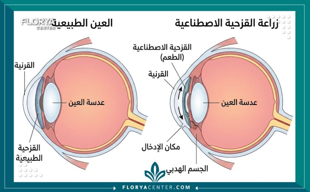 رسم تخطيطي طبي يوضح تشريح العين وكيفية إدخال القزحية الاصطناعية وتثبيتها داخل الحجرة الأمامية للعين لعلاج التشوهات.