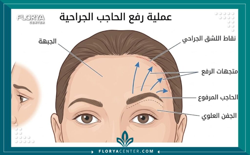 سعر عملية رفع الحواجب الجراحية في تركيا 2 رسم توضيحي طبي يشرح خطوات عملية رفع الحواجب الجراحية وأماكن الشقوق الجراحية في الجبهة.