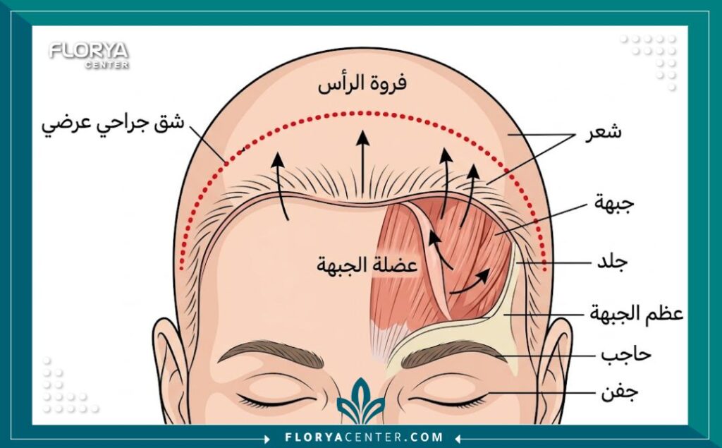 مخطط طبي يوضح الشق الجراحي العرضي (Coronal Incision) لعملية شد الجبهة التقليدية وعضلات الوجه المعنية.
