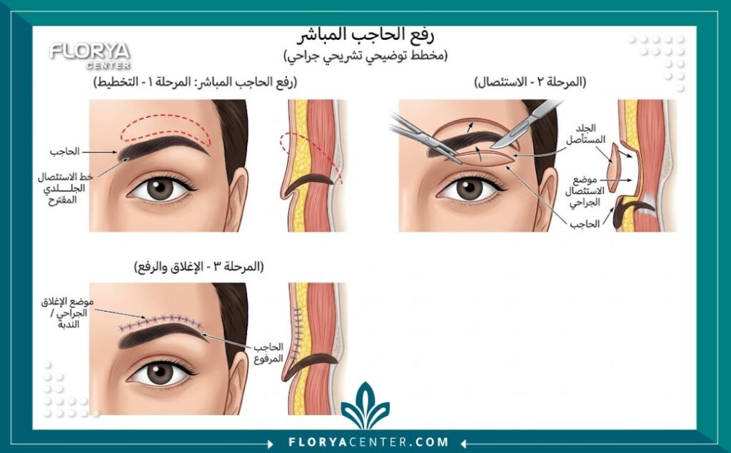 شد الحواجب المباشر في تركيا 2 رسم توضيحي طبي يشرح تشريحياً كيفية إجراء عملية شد الحواجب المباشر وقص الجلد الزائد مباشرة فوق الحاجب.
