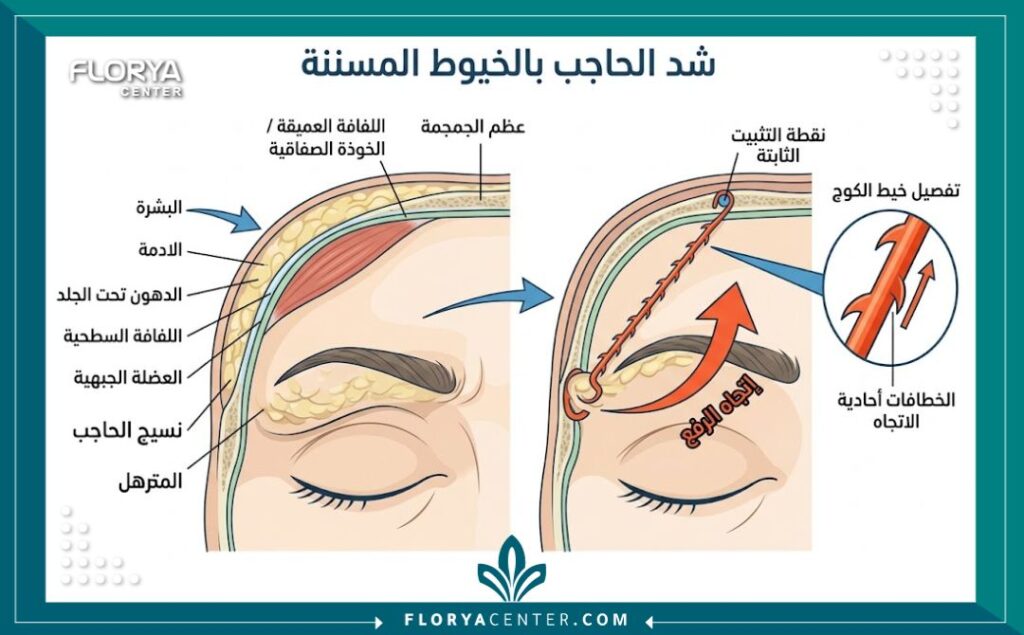 رسم توضيحي طبي يشرح آلية عمل خيوط الكوج ذات الخطاطيف في اختراق الأنسجة ورفع الحاجب المتهدل.